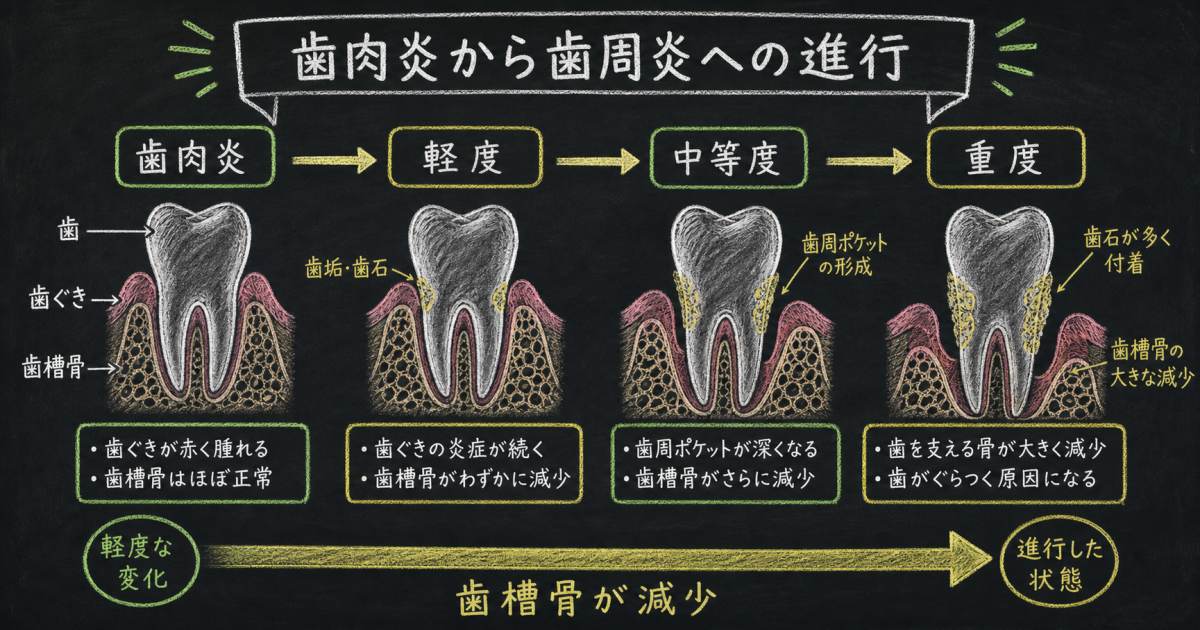歯周病を放置するとどうなる?段階的に進む病状と歯を失う仕組み